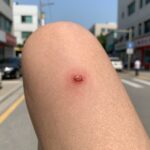 개미 물린 자국 붉고 부은 증상