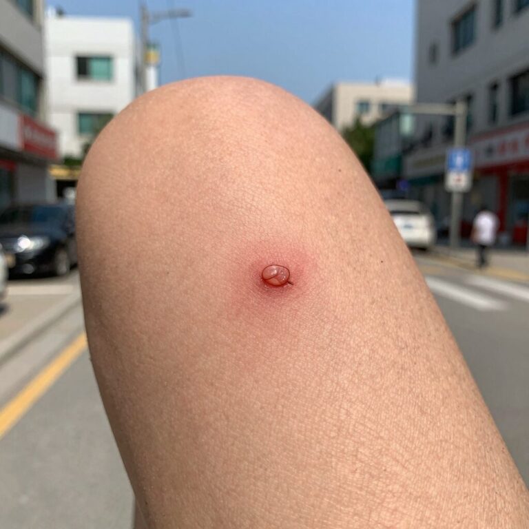 개미 물린 자국 붉고 부은 증상